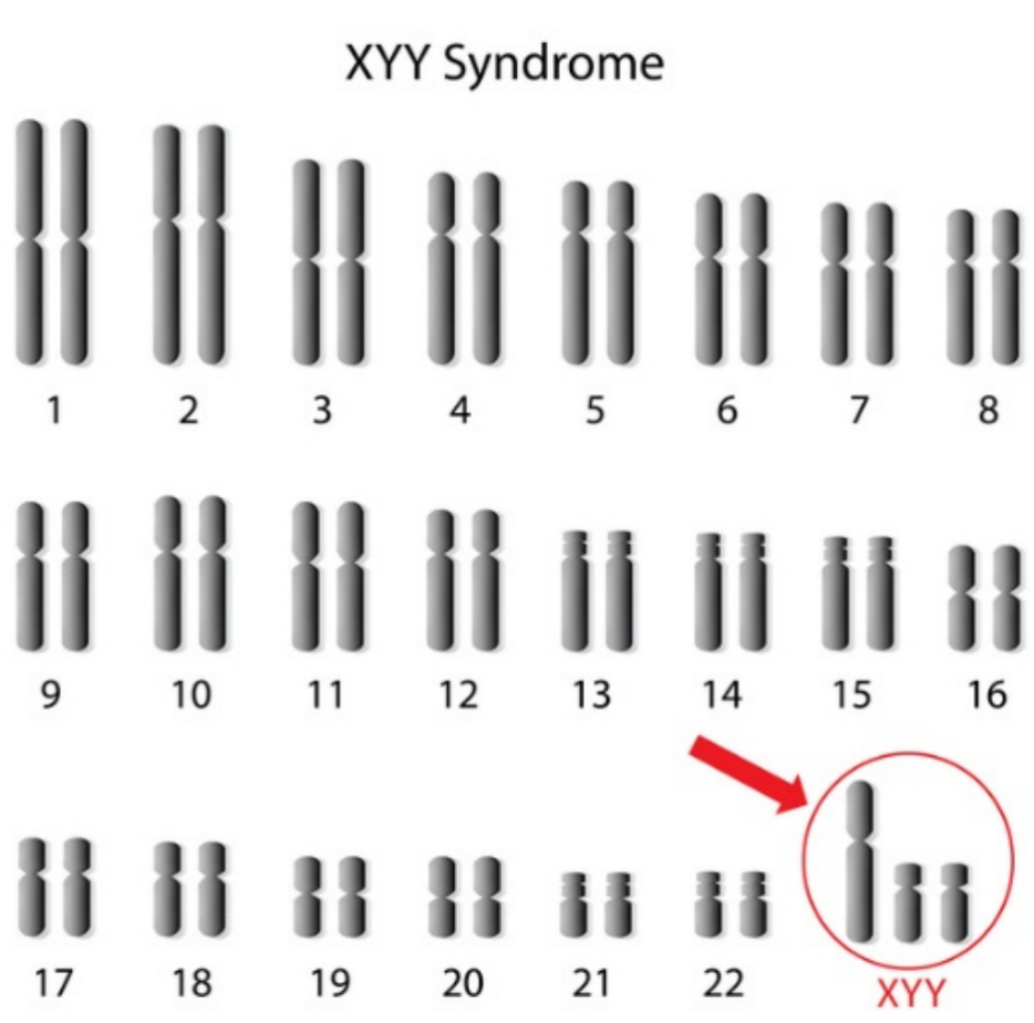 超雄综合征患者还能正常生育?怀了超雄综合征的宝宝该怎么办?专家解析→